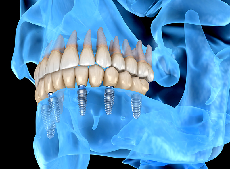Quanto costa un impianto dentale completo