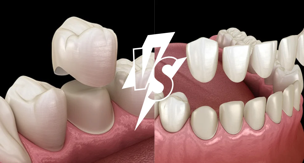 Crowns vs Veneers