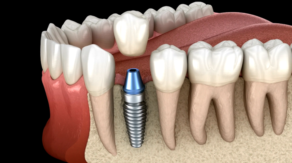 Implantet Dentare: Pyetjet më të shpeshta