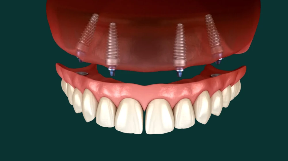Arcata dentale superiore prezzi