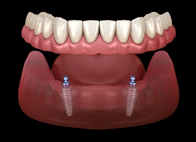 Mini dental implants cost