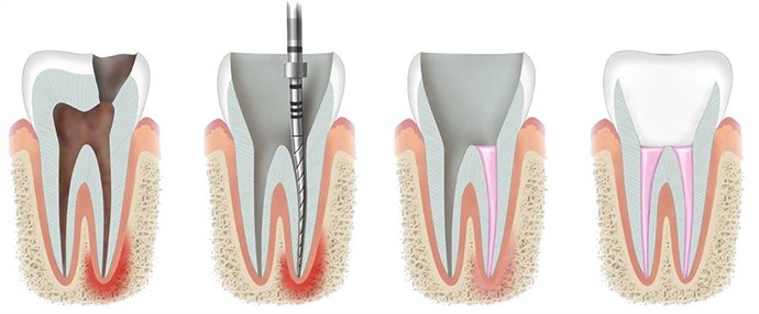 Cosa significa devitalizzare un dente?