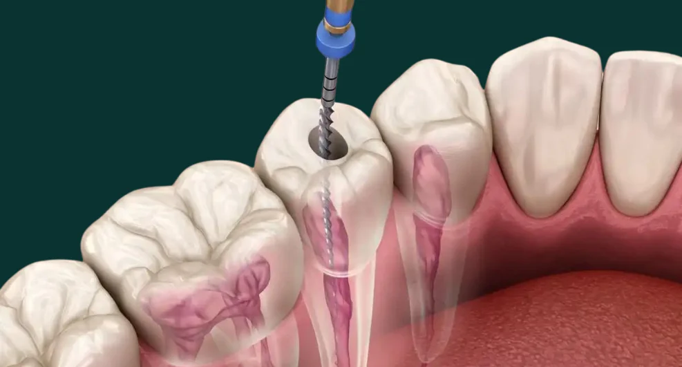 Cosa significa devitalizzare un dente?