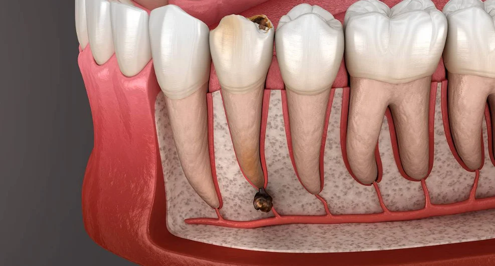 Wurzelspitzenresektion Kosten