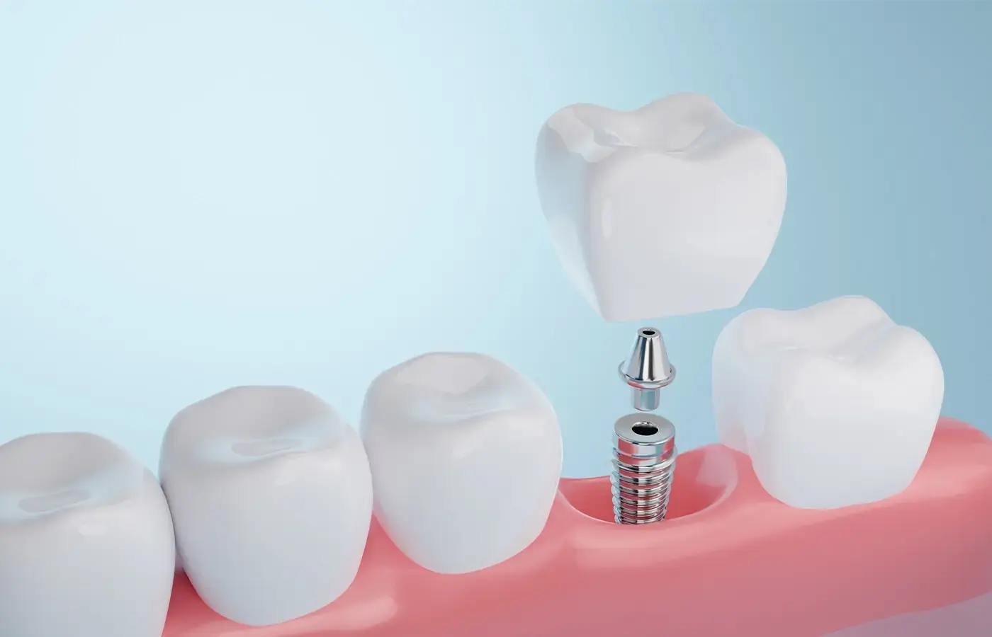 Perché Scegliere gli Impianti Dentali al Titanio?