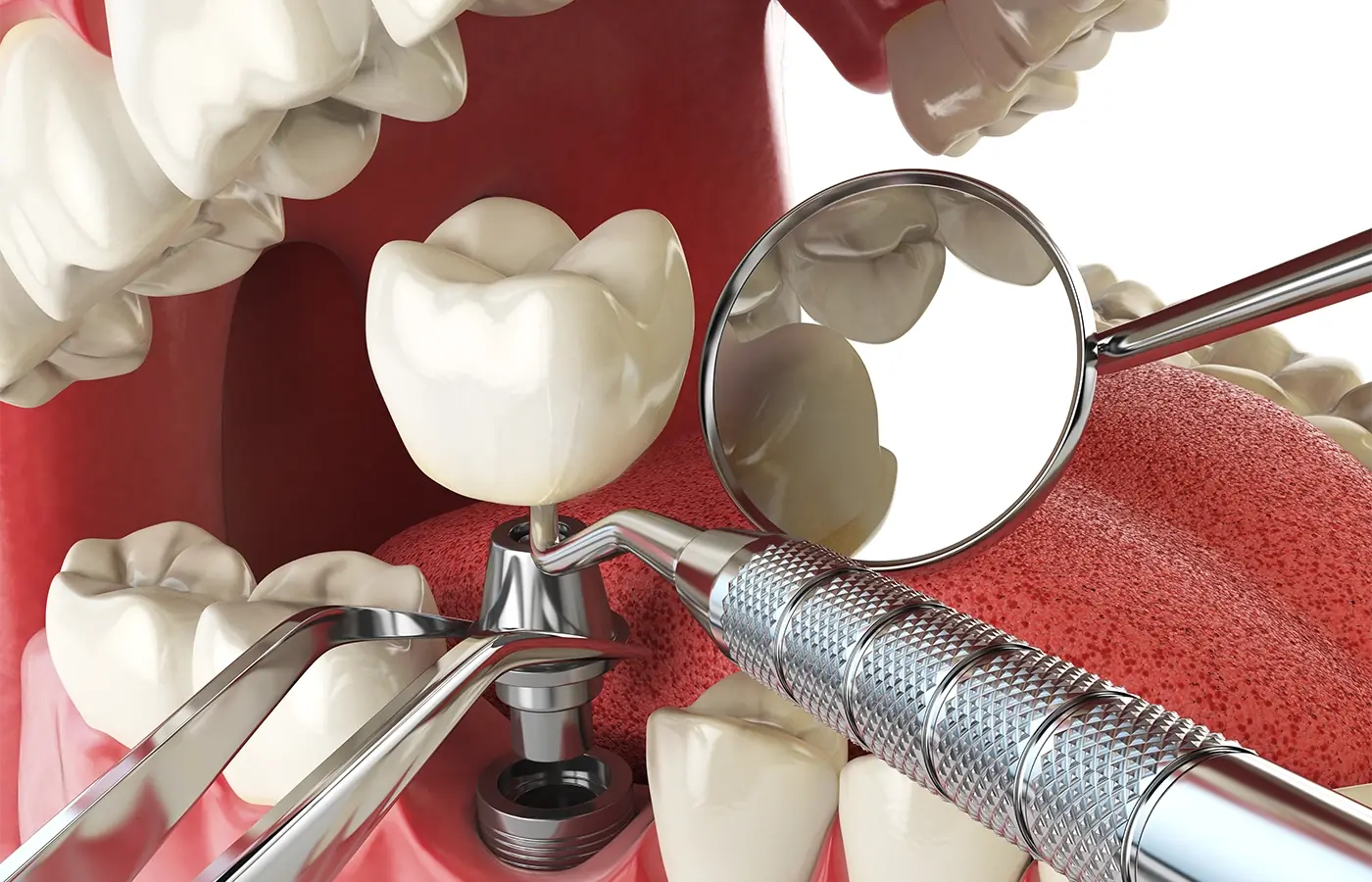 All-on-6 Dental Implants, Price Comparison in Albania, Turkey, and Italy