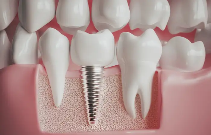 Can You Have Dental Implants with Gum Disease?