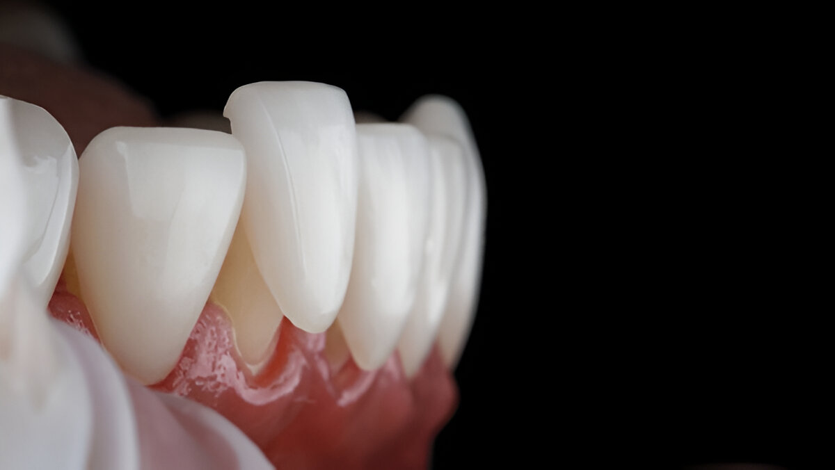 Miglior materiale composito per corone dentali: quale scegliere?