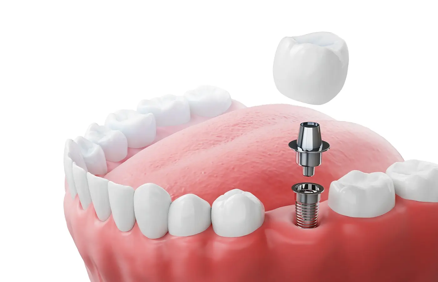 Quali sono i costi per un impianto dentale?