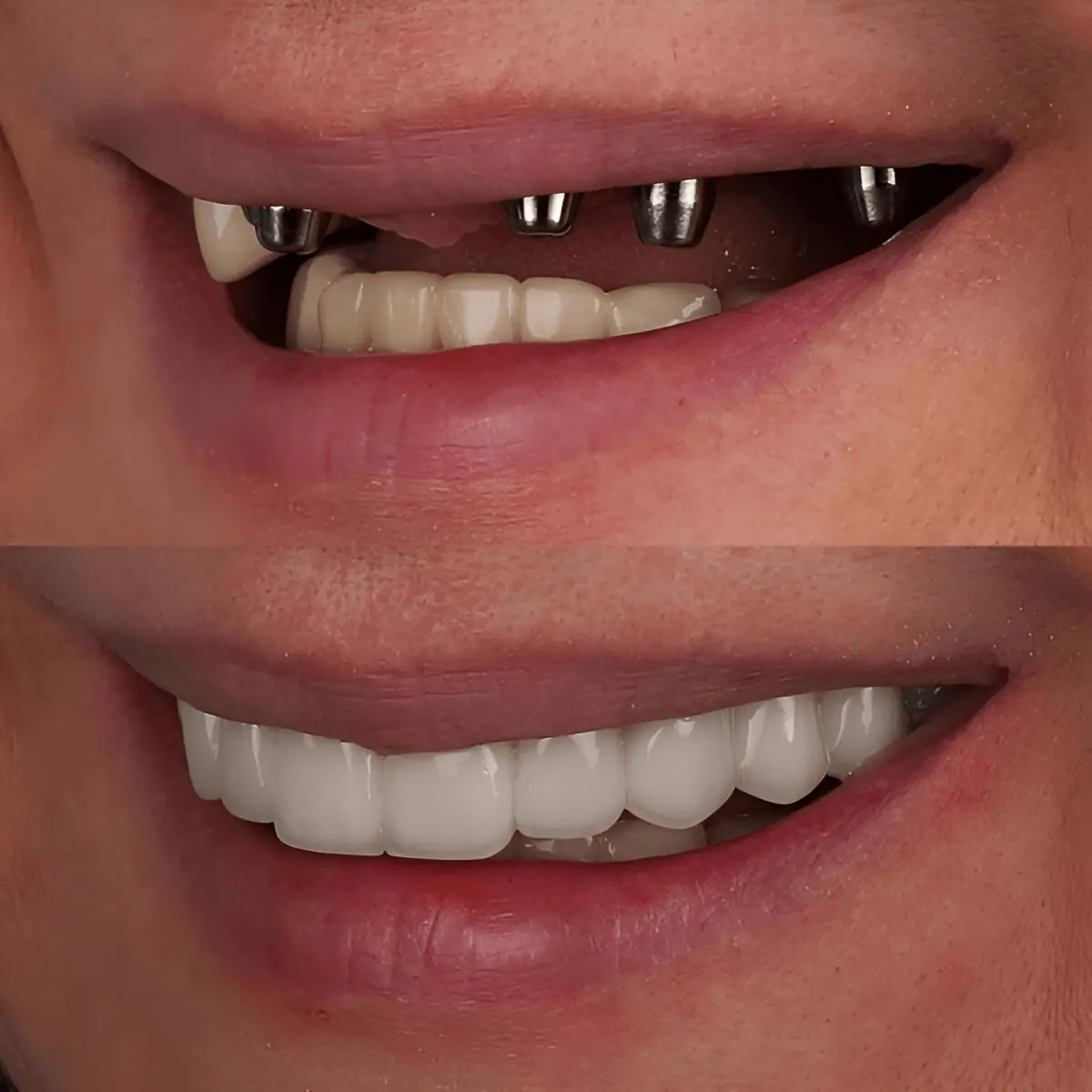 Why Does Albania Offer the Best All on 4 Dental Implants in Europe?