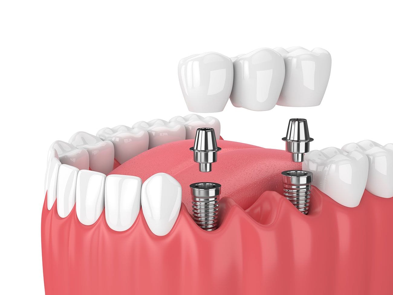 Quanto costano gli impianti dentali? Guida completa ai prezzi e fattori da considerare