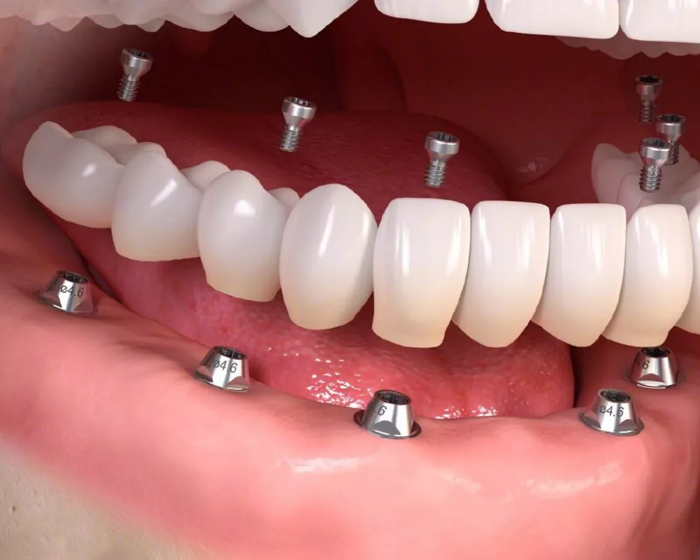 How Much Do All on 6 Implants Cost in Albania Compared to Italy?