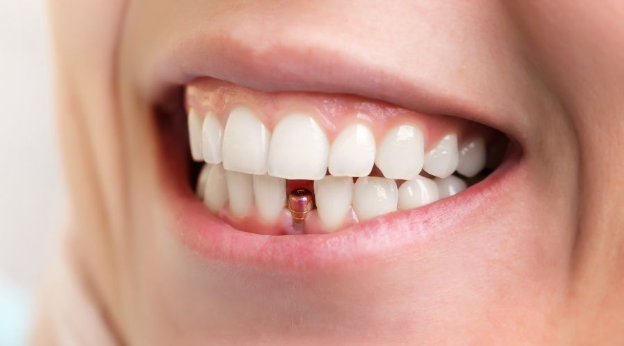 How Much Are Dental Implants in Albania? A Complete Guide for Patients