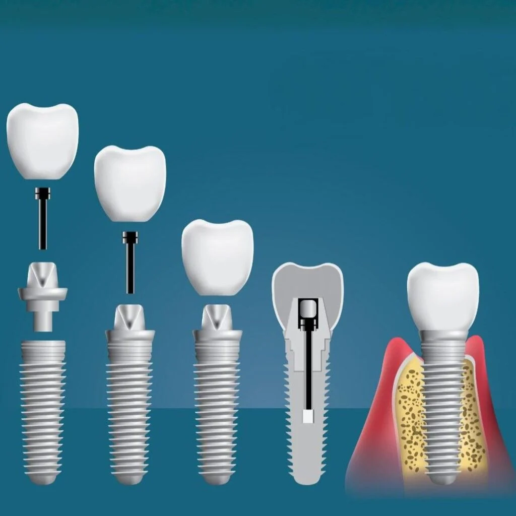 In questo articolo scopriremo i prezzi reali degli impianti dentali, le differenze tra Italia e Albania, il ruolo delle cliniche moderne e dello staff altamente qualificato, e come funziona l’intero percorso del paziente — dal preventivo gratuito fino al rientro a casa con un sorriso nuovo.